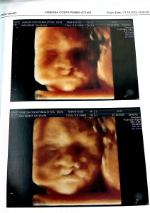 Ultrassonografia morfológica fetal